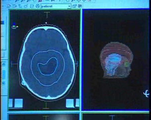 Tecnología para la salud. Radioterapia.